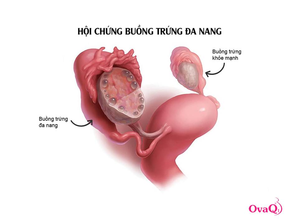 Đa nang ảnh hưởng đến lớp niêm mạc tử cung, ngăn cản quá trình làm tổ của bào thai