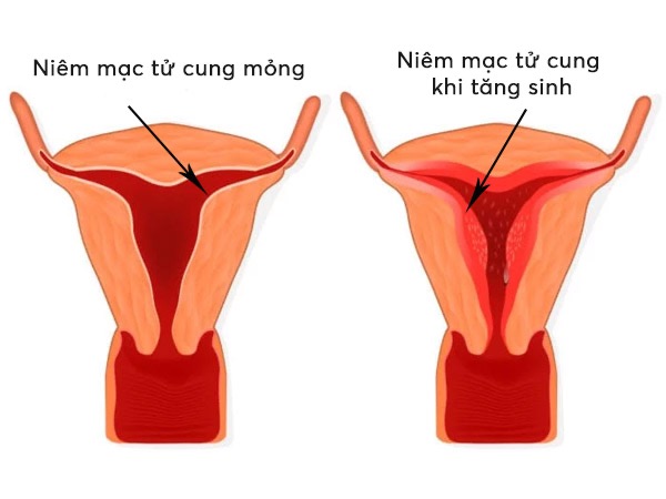 Niêm mạc tử cung dày hay mỏng đều ảnh hưởng đến khả năng thụ thai. 