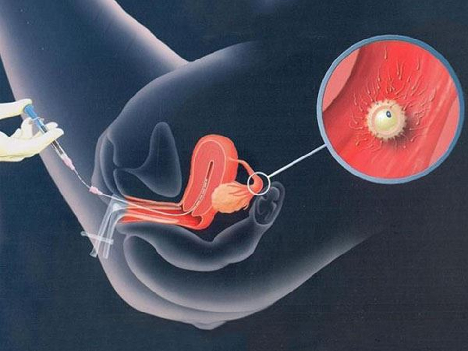 Bơm tinh trùng vào tử cung của vợ diễn ra thế nào?