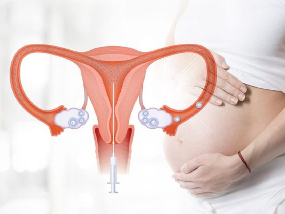 IUI là phương pháp hỗ trợ sinh sản bơm tinh trùng vào tử cung